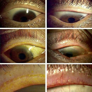 ophthalmology MCQ only - Telegram Channel